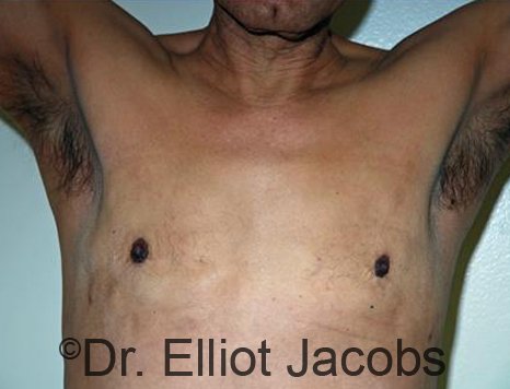 Male breast, after gynecomastia Adolescent treatment, front view, patient 1
