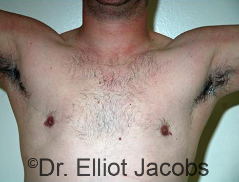 Male breast, after gynecomastia Adolescent treatment, front view, patient 2