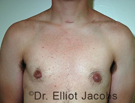 Male breast, after FTM Top Surgery treatment, front view, patient 1