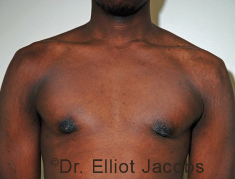Male breast, after Puffy Nipple Reduction treatment, front view, patient 3