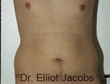 Male breast, before Torsoplasty treatment, front view, patient 2