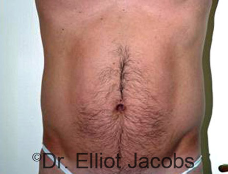 Male body, before Torsoplasty treatment, front view - patient 1