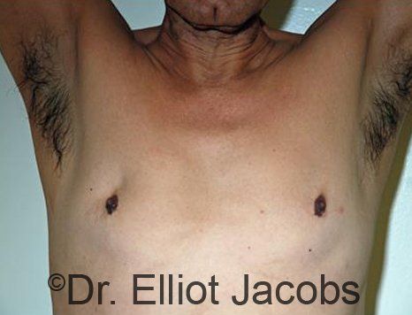 Male breast, before gynecomastia Adolescent treatment, front view, patient 1