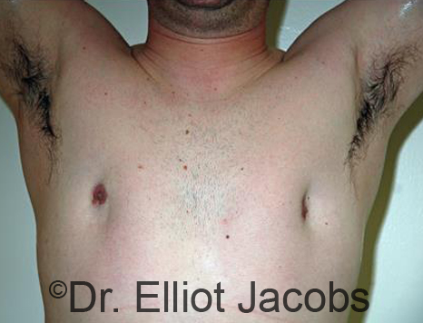 Male breast, before gynecomastia Adolescent treatment, front view, patient 2