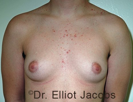 Male breast, before FTM Top Surgery treatment, front view, patient 1