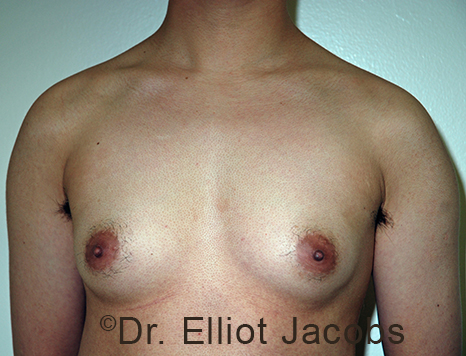 Male breast, before FTM Top Surgery treatment, front view, patient 2