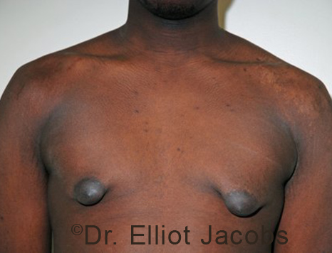 Male breast, before Puffy Nipple Reduction treatment, front view, patient 3