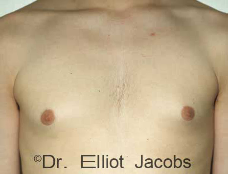 Male breast, before gynecomastia Adolescent treatment, front view, patient 2