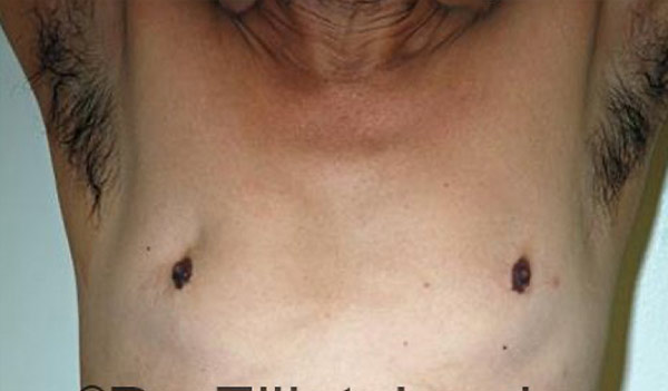 Male breast, before Revision Gynecomastia Surgery, front view, patient 1