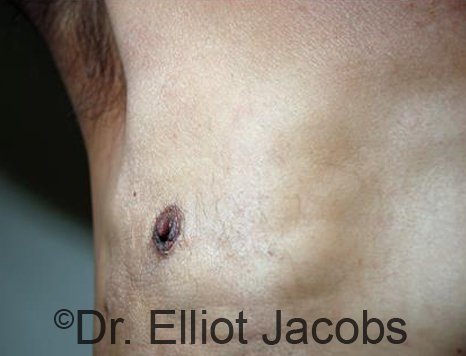 Revision Gynecomastia - Photos After Treatment: male patient 2 (frontal view, nipple)