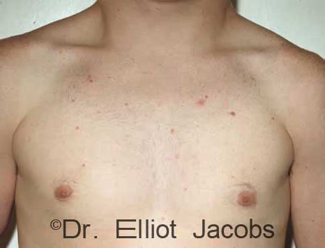 Gynecomastia Adolescents - After Treatment Photo - male (frontal view)