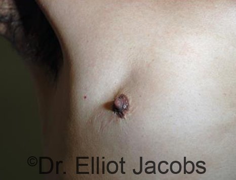Revision Gynecomastia - Photos Before Treatment: male patient 2 (frontal view, nipple)