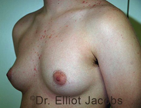 Nipple Reduction: Before Treatment Photo - male patient 1 (left side oblique view)