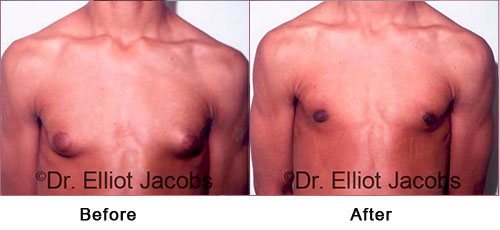 ADOLESCENT GYNECOMASTIA. Before and After Photo - man (frontal view)