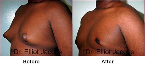 ADOLESCENT GYNECOMASTIA. Before and After Photo - male (left side, oblique view)