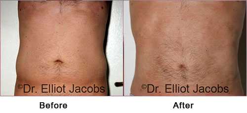 TORSOPLASTY - Before and After Photos - man, tummy (frontal view)