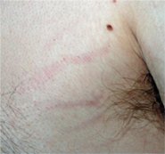Stretch-Marks