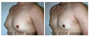 Gynecomastia Adults. Before and After Treatments Photos: male patient - left side,oblique view
