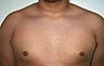 Gynecomastia Adolescents - Before and After Treatment Photos - man breasts (frontal view) patient 21