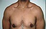 Gynecomastia Adolescents - Before and After Treatment Photos - man breasts (frontal view) patient 22