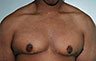 Gynecomastia Adolescents - Before and After Treatment Photos - man breasts (frontal view) patient 23 