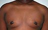 Gynecomastia Adolescents - Before and After Treatment Photos - man breasts (frontal view) patient 24