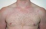 Gynecomastia Adolescents - Before and After Treatment Photos - man breasts (frontal view) patient 25