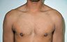 Gynecomastia Adolescents - Before and After Treatment Photos - man breasts (frontal view) patient 26