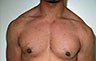 Gynecomastia Adolescents - Before and After Treatment Photos - man breasts (frontal view) patient 27