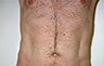 Torsoplasty - Before and After Treatment photos: male body (breasts), front view, patient 7