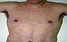 Torsoplasty - Before and After Treatment photos: male body (breasts), front view, patient 9