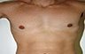 Torsoplasty - Before and After Treatment photos: male body (breasts), front view, patient 10