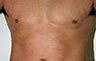 Torsoplasty - Before and After Treatment photos: male body (breasts), front view, patient 13