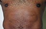 Torsoplasty - Before and After Treatment photos: male body (breasts), front view, patient 15