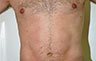 Torsoplasty - Before and After Treatment photos: male body (breasts), front view, patient 16