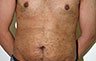 Torsoplasty - Before and After Treatment photos: male body (breasts), front view, patient 20