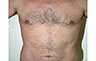 Torsoplasty - Before and After Treatment photos: male body (breasts), front view, patient 21