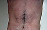 Torsoplasty - Before and After Treatment photos: male body (breasts), front view, patient 22