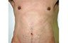 Torsoplasty - Before and After Treatment photos: male body (breasts), front view, patient 23