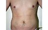 Torsoplasty - Before and After Treatment photos: male body (breasts), front view, patient 24