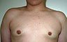 Gynecomastia Adolescents - Before and After Treatment Photos - man breasts (frontal view) patient 28