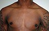 Gynecomastia Adolescents - Before and After Treatment Photos - man breasts (frontal view) patient 29