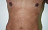 Torsoplasty - Before and After Treatment photos: male body (breasts), front view, patient 25