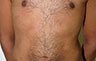 Torsoplasty - Before and After Treatment photos: male body (breasts), front view, patient 26
