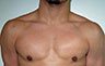 Gynecomastia Adolescents - Before and After Treatment Photos - man breasts (frontal view) patient 31