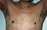 Revision Gynecomastia - Photos Before Treatment: frontal view, male patient 1