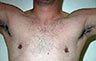 Revision Gynecomastia - Photos Before Treatment: frontal view, male patient 2