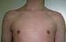 Gynecomastia Adolescents - Before and After Treatment Photos - man breasts (frontal view) patient 32