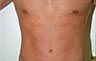 Torsoplasty - Before and After Treatment photos: male body (breasts), front view, patient 29