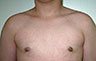 Gynecomastia Adolescents - Before and After Treatment Photos - man breasts (frontal view) patient 33